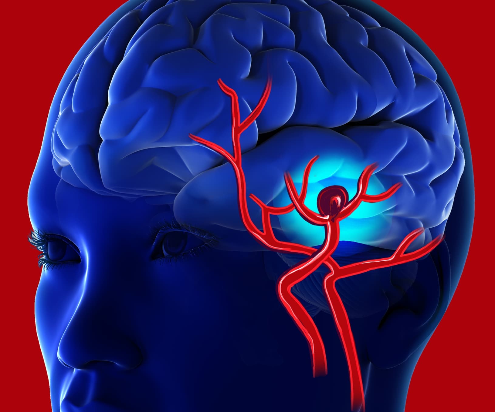 Brain Aneurysms